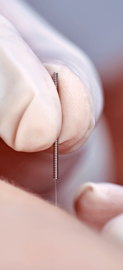 Nahafnahme: Eine Hand steckt eine dünne Nadel in die Haut eines Patienten.