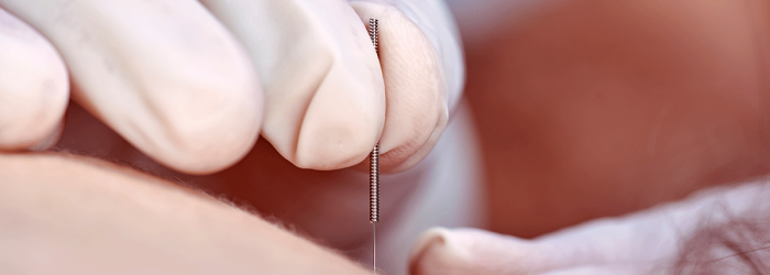 Nahafnahme: Eine Hand steckt eine dünne Nadel in die Haut eines Patienten.